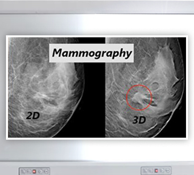 Mammography - News Thumb